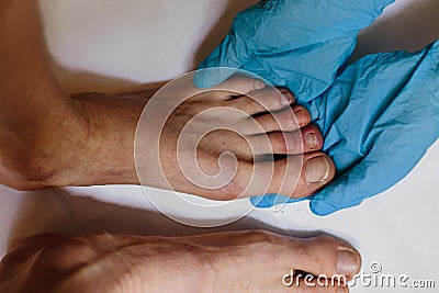 Mysterious skin condition that causes purple, blue or red discoloration in toes and occasionally fingers. New symptom of Stock Photo