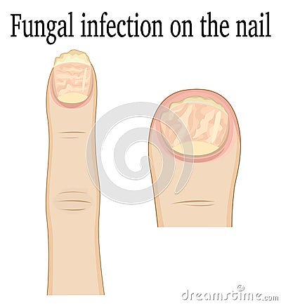 Nail fungal infection Vector Illustration