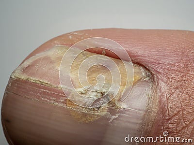 Nail infections caused by fungi such as: onychomycosis also known as tinea unguium. Thumb infection Stock Photo