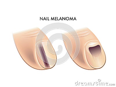 Nail melanoma Vector Illustration