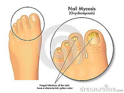 Nail mycosis Vector Illustration