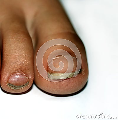 Nails on the feet, dirty. Ingrown toenails. Black dirty fingernails. Stock Photo