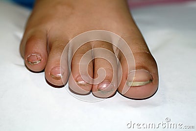 Nails on the feet, dirty. Ingrown toenails. Black dirty fingernails. Stock Photo