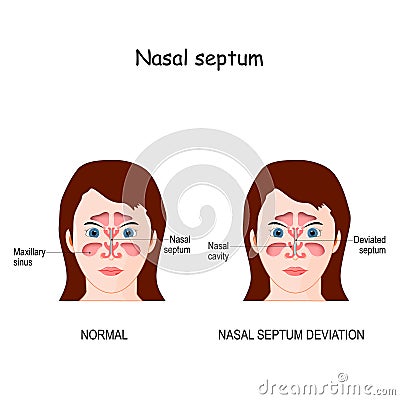 Nasal septum deviation Vector Illustration