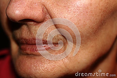 Nasolabial wrinkled fold on the skin of the face. Stock Photo