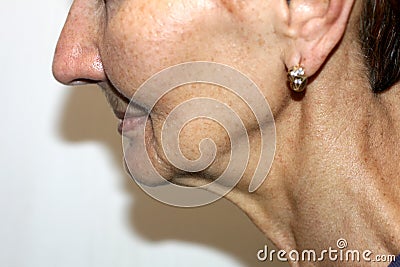 Nasolabial wrinkles. Wrinkles on the skin of the face of the neck. Flabby cheeks and neck Stock Photo