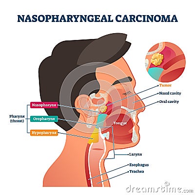 Nasopharyngeal carcinoma tumor, vector illustration Vector Illustration