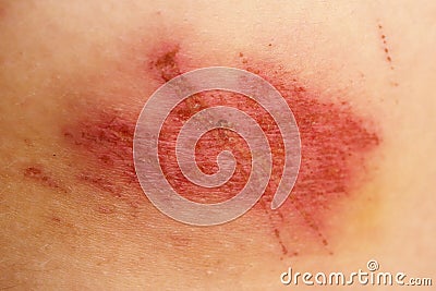 Nasty wound Stock Photo
