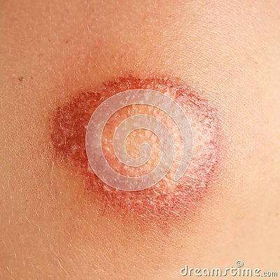 Nasty wounds Stock Photo