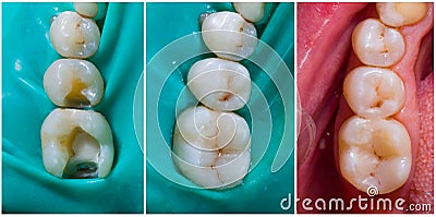 Upper molar and premolar aesthetic filling Stock Photo