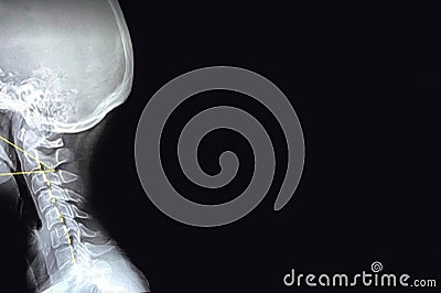 Neck Injury X-Ray Image Stock Photo