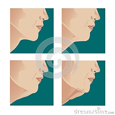 Neck lift Stock Photo