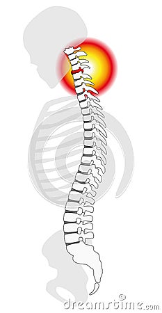 Neck Pain Cervical Vertebrae Spinal Disc Prolapse Vector Illustration