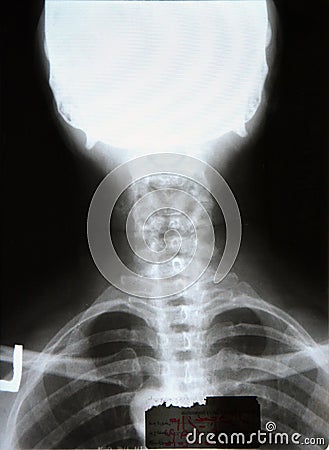 Neck skull xray (x-ray) Stock Photo