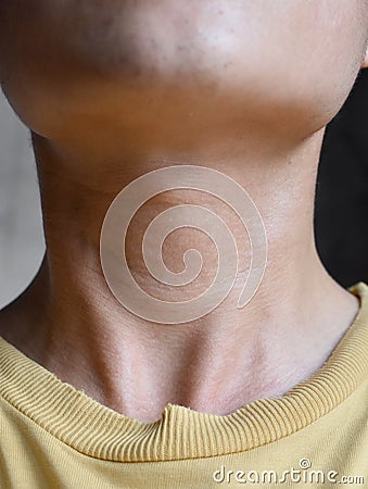 Neck swelling diagnosed as hyperthyroidism. Aging skin folds or skin creases or wrinkles at neck of Asian, Chinese young man Stock Photo