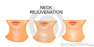 Neck, wrinkles, rejuvenation Vector Illustration