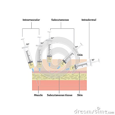 Needle Angles illustration vector on white background. Health Vector Illustration