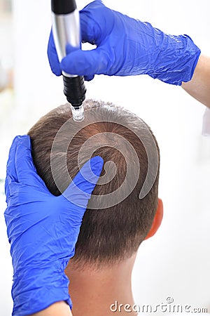 Needle mesotherapy of the scalp. Stock Photo