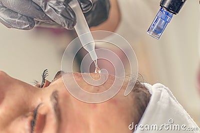 Needle mesotherapy treatment on a woman face. Stock Photo