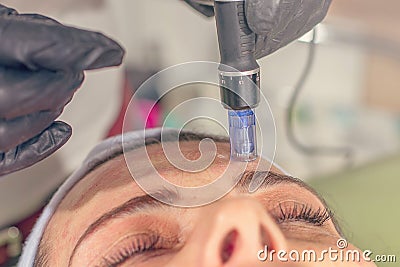 Needle mesotherapy treatment on a woman face. Stock Photo