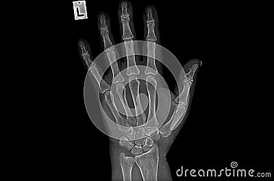 Negative 3D illustration X ray image of human hand Rheumatism Cartoon Illustration