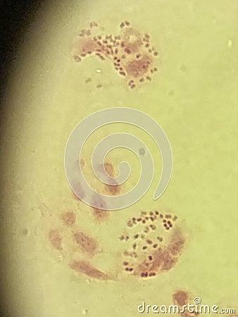 Neisseria gonorrhea - intracellular Gram negative diplococci Stock Photo