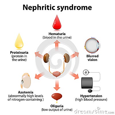 Nephritic syndrome Vector Illustration