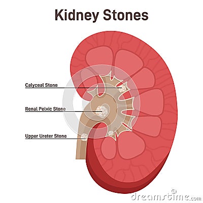 Nephrolithiasis. Kidney stones disease. Nephrology and urology Vector Illustration