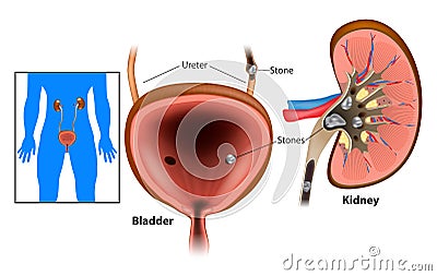 Kidney stones diseas Vector Illustration