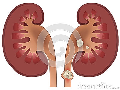 Nephrolithiasis kidney stones disease Vector Illustration