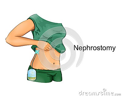 Nephrostomy in the right kidney with drainage bag Cartoon Illustration