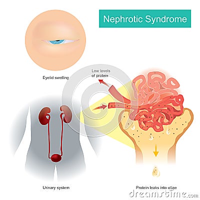 Nephrotic Syndrome. Illustration explain A kidney disorder that causes your body to pass too much protein in your urine Vector Illustration