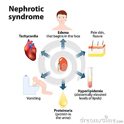 Nephrotic syndrome Vector Illustration