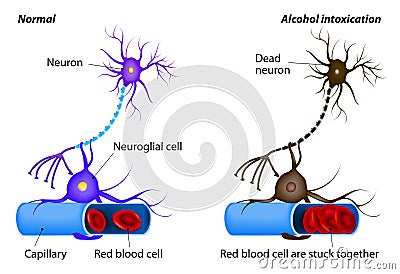 Nerve damage caused by heavy alcohol intoxication Vector Illustration