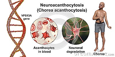 Neuroacanthocytosis, or Chorea acanthocytosis, a neurodegenerative disease, conceptual 3D illustration Cartoon Illustration