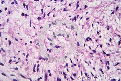 A neurofibroma tissue sample in neurofibromatosis genetic disease, light micrograph Stock Photo