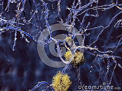 Neuron with amyloid plaques Stock Photo