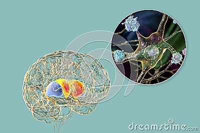 Neuronal inclusions in Huntington's disease, 3D illustration Cartoon Illustration