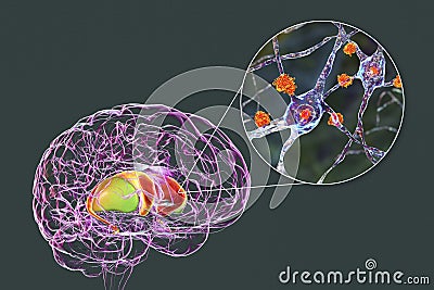 Neuronal inclusions in Huntington's disease, 3D illustration Cartoon Illustration