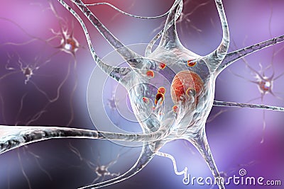 Neurons in Parkinson& x27;s disease Cartoon Illustration