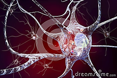 Neurons in Parkinson& x27;s disease Cartoon Illustration