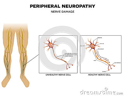 Neuropathy, nerve damage Vector Illustration