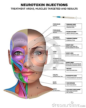 Neurotoxin injection Vector Illustration
