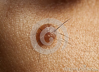 Nevus Hair Stock Photo