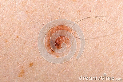 Nevus on human skin Stock Photo