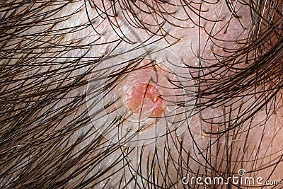 Nevus sebaceus on scalp Stock Photo