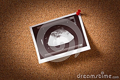 New life on ultrasound image Stock Photo