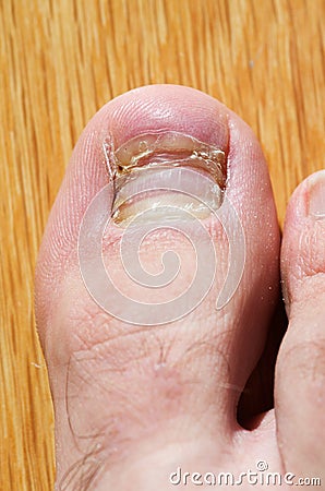 New toenail Stock Photo