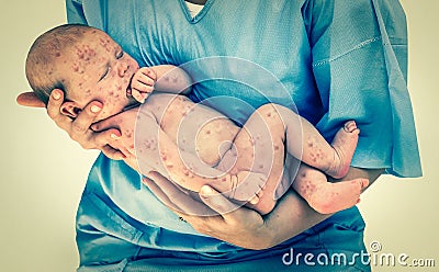 Newborn baby with chickenpox - retro style Stock Photo