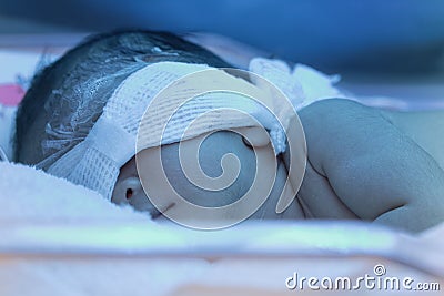 Newborn baby with neonatal jaundice under blue UV light Stock Photo